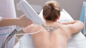 Tattoo Removal (Q-Switch Laser) Treatment