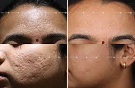Acne & Scar Treatment