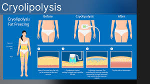 Cryolipolysis Treatment