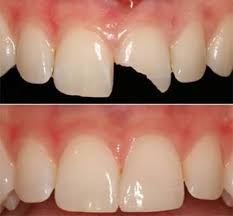Cosmetic ( Tooth Coloured) Fillings