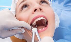 Teeth Extraction ( Wisdom Tooth Surgery)