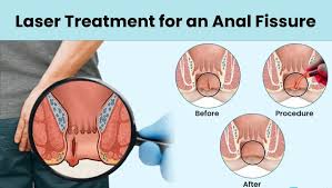 Anal Fissure Treatment