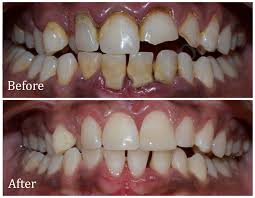 Tooth Coloured Filling