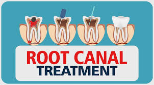 Root Canal Treatment