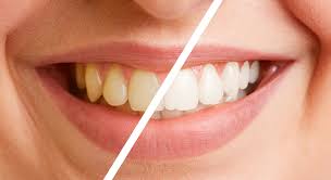 Teeth Cleaning And Polishing