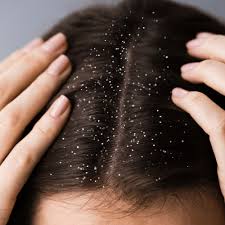 Hair Dandruff Treatment